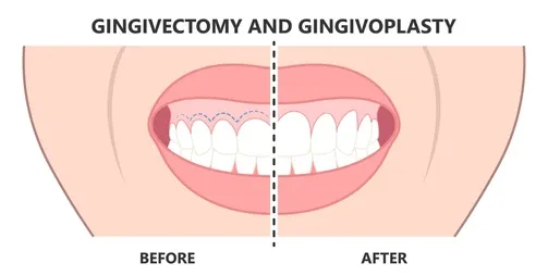 Gingivoplasty